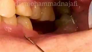 کاشت ایمپلنت