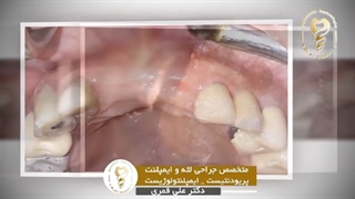 فیلم جراحی ایمپلنت همزمان ٢ دندان همراه با بازسازی استخوان