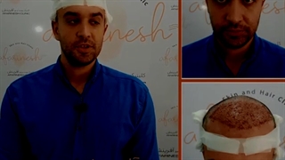کاشت مو با بالاترین تراکم | کلینیک آفرینش