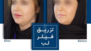 تزریق فیلر لب