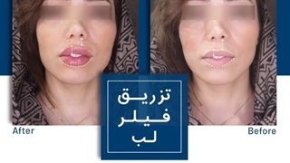 تزریق فیلر لب روسی