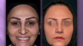 جراحی بینی نیمه فانتزی زنانه | دکتر رفیع