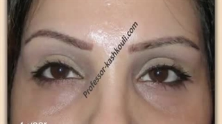 لیفت آندوسکوپی پیشانی ، شقیقه و ابرو | پروفسور کشکولی