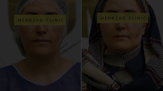 نمونه کار تزریق چربی صورت دندانپزشکی کودکان