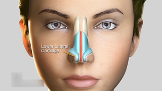 جراحی بینی راز جراحی