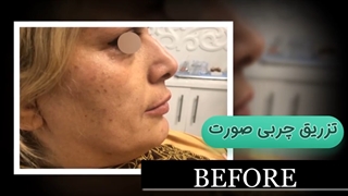 فیلم تزریق چربی صورت پر کردن دندان