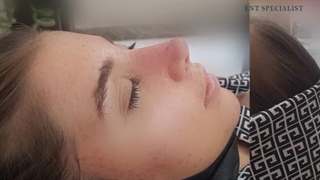 یک ماه پس از جراحی بینی
