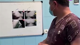 جراحی ژنیکوماستی شدید در آقای 27 ساله| دکتر مهدی آریانا