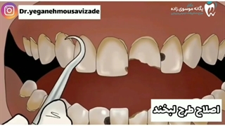 اصلاح طرح لبخند