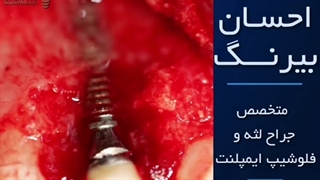 فیلم درمان تحلیل بافت استخوان اطراف ایمپلنت و تقویت بافت نرم