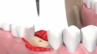 کاشت ایمپلنت دندان