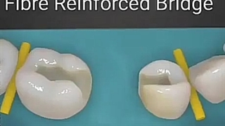 بریج دندانپزشکی تقویت شده با فیبر