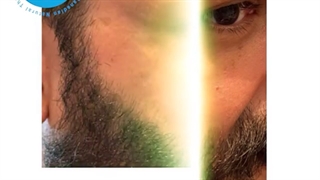 ترمیم دفرمگی با تزریق فیلر توسط دکتر آذر مسرور| کالج ctaa