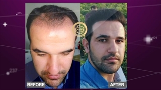 کاشت مو تخصصی