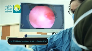 درمان نازایی با ایجاد خراش در رحم