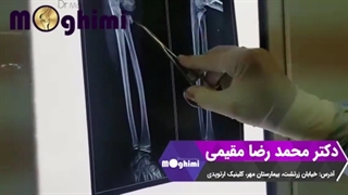 عمل جراحی شکستگی سر رادیوس در کودک 8 ساله