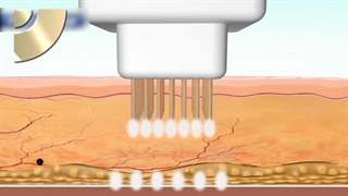 جوانسازی پوست با آر اف پلاستیک لثه