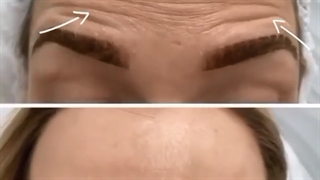 فیلم معجزه تزریق بوتاکس پیشانی