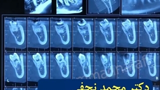 جراحی دندان عقل نهفته