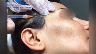 فیلم واقعی از تزریق ژل به شقیه جهت فرم دهی در مطب دکتر مولازاده