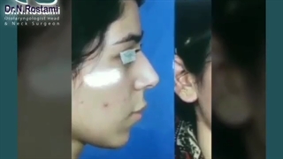 فیلم عمل بینی استخوانی دخترانه