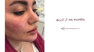فیلم فرم دهی صورت بلافاصله پس از تزریق چربی