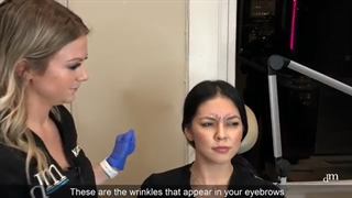 تاثیر شگفت انگیز بوتاکس بر خط اخم