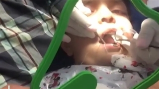 عصب کشی دندان کودک