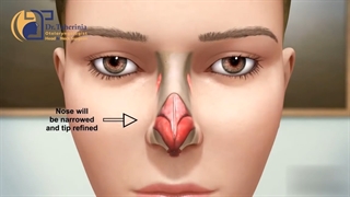 فیلم واقعی از عمل جراحی زیبایی بینی