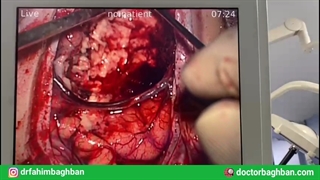 تومور گلیومای فرونتال