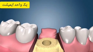 ایمپلنت