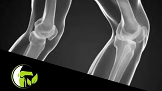 مراقبت های بعد از جراحی مفصل زانو چگونه است؟