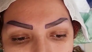 فیلم قبل و بعد از کاشت ابرو| کلینیک ابروان