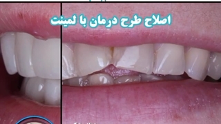 اصلاح طرح درمان با لمینت
