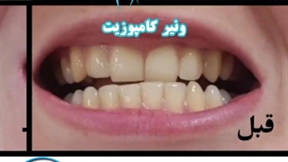 قبل و بعد از ونیر کامپویزیت دندان