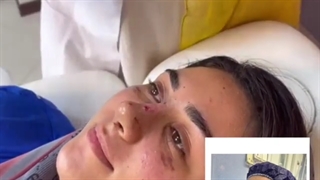 فیلم قبل و بعد عمل زیبایی بینی