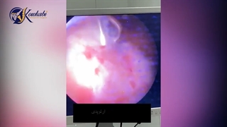 فیلم واقعی از عمل آرتروسکوپی ترمیم پارگی روتاتورکاف در اتاق عمل