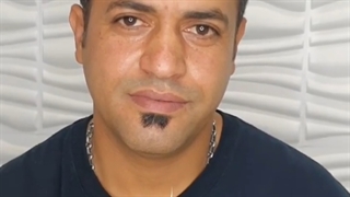 کاشت مو در تهران