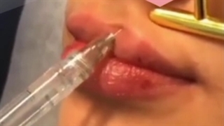 تزریق چربی به لب جراحی لثه