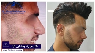 جراحی زیبایی بینی