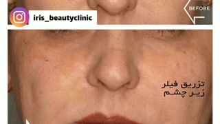 فیلم رفع گودی زیر چشم با تزریق فیلر