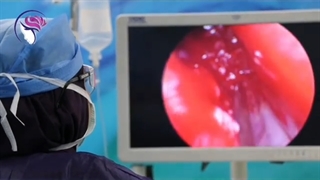 آیا جراحی همزمان بینی، پولیپ و سینوزیت امکان پذیر هست؟