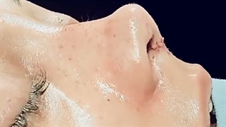 فیلم جراحی بینی نیمه طبیعی بلافاصله پس از عمل