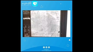 آنژیوپلاستی در عروق پیچ خورده گردن