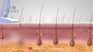 چه نکاتی را باید قبل و بعد از لیزر موهای زائد رعایت کرد؟