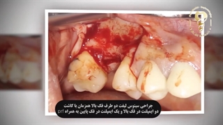 فیلم واقعی جراحی ایمپلنت دندان همزمان با سینوس لیفت