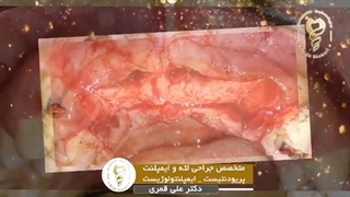 فیلم واقعی ایمپلنت ۴ دندان فک بالا و بازسازی استخوان با پی آر اف