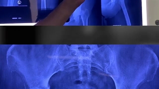 رماتیسم مفصلی شدید