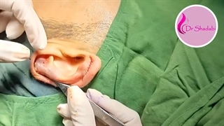 جراحی گوش