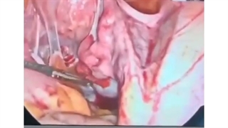 جراحی اندومتریوز